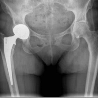 Anteroposterior Radiograph Of The Pelvis Showing The Right Total Hip