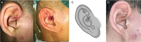 Variant Types Of Preauricular Sinuses Classifications Clinical