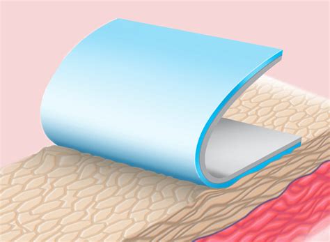 Silflex – Advancis Medical