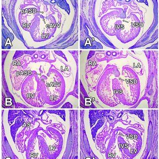 Deletion of Sox9 from the SHF results in atrial and ventricular septal ... 