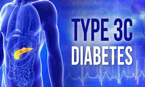 السكري من النوع 3c الأسباب والأعراض وأهم طرق التشخيص والعلاج