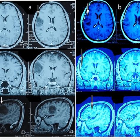 Brain MRI A Pre Operative Brain MRI With Contrast Showing A