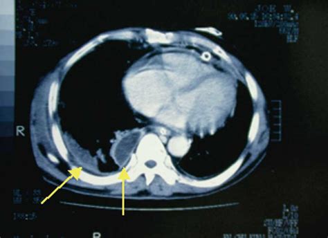 Chest CT With Contrast At 5 Days After Admission Revealed Right Side