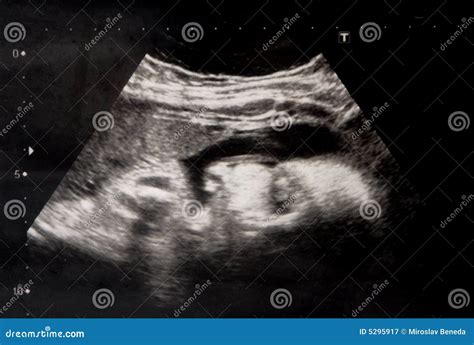 Baby - ultrasound stock image. Image of ultra, sound, child - 5295917