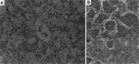 Liver From Af Treated Group A Severe Hydropic Degeneration Of