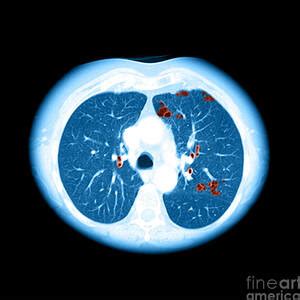 Emphysema On Ct Chest Photograph by Medical Body Scans - Pixels