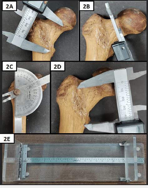 Measurements Of Different Parameters Of The Proximal End Of The Femur