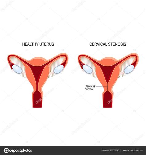 Stenosis Of Uterine Cervix Human Fertility Stock Vector Image By