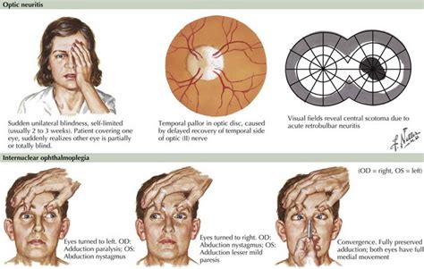 Multiple Sclerosis Clinical Gate