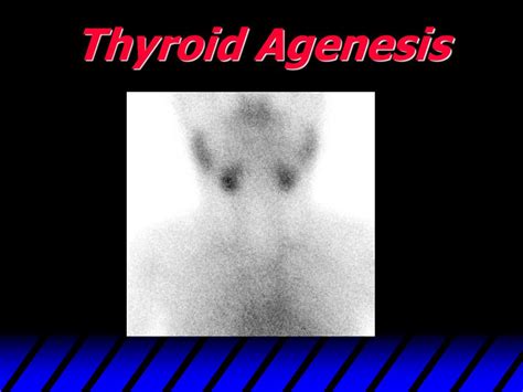 Ppt Thyroid Scan Powerpoint Presentation Free Download Id437897