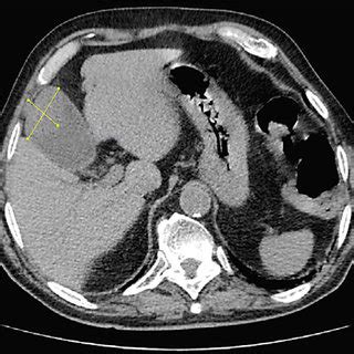 Lesion Located At The Gallbladder Fundus With A Congestive Surface