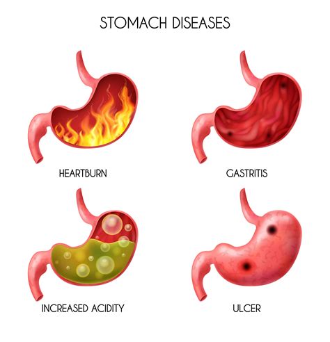 Stomach Diseases: Causes, Symptoms, Prevention, and Treatment - Health