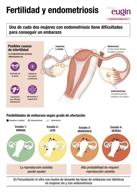 Cómo afecta la endometriosis a tu fertilidad Eugin