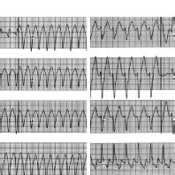 Twelve Lead Surface Electrocardiograms Of Induced Ventricular