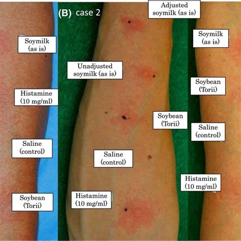 The Results Of Skin Prick Test Commercial Soybean Extract And Soymilk