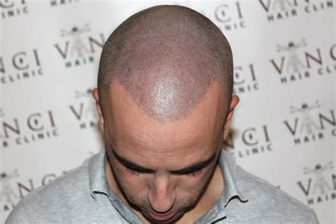 7 Scalp Micropigmentation Side Effects, Risks & Warnings - Bald & Beards