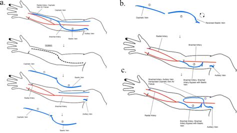 POWR DRIL Proximalization Through One Incision Of A WRist Av Fistula