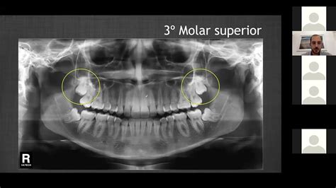 Cirurgia Dos Dentes Inclusos Prof Dr Bruno Dias Youtube