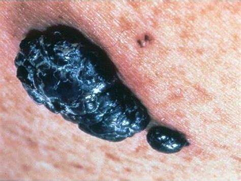 Identifying moles - Skin cancer or mole? How to tell - Pictures - CBS News