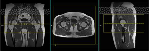 Mri Arthrogram Hip Protocol And Planning Indications For Mri