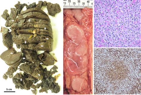 Rare Presentation Of Fatal Atraumatic Splenic Rupture In Follicular