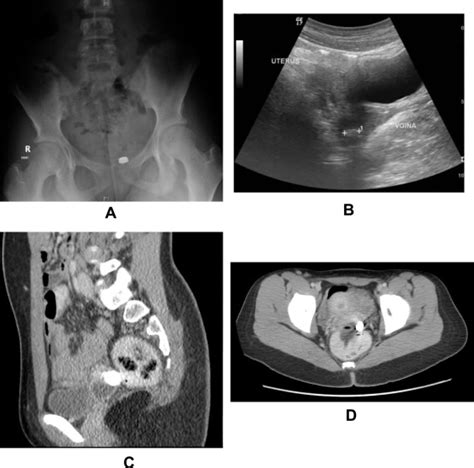 Longstanding Presence Of A Vaginal Foreign Body Battery Severe