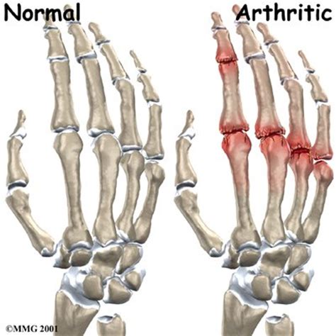 Wrist and Hand Osteoarthritis - Physiopedia