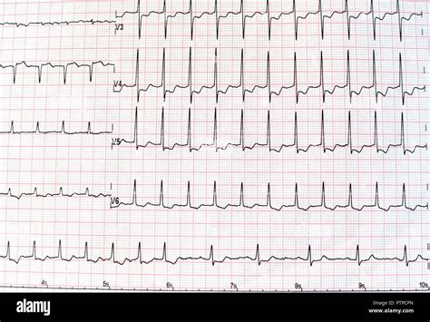 Cardiogram Waveform From An Ekg Showing Abnormal Ekg Test A Off