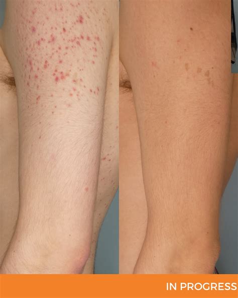 Psoriasis Before And Afters Dermatology Clinics Australia