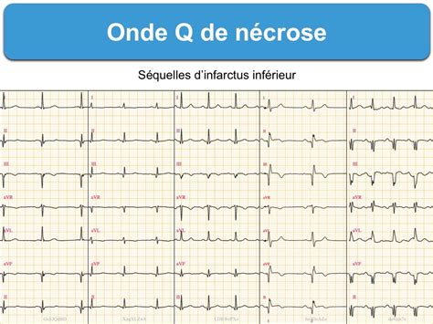 D Finitions Page Sur E Cardiogram