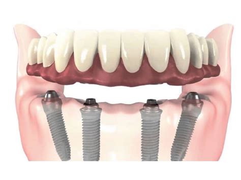 Pr Tesis Fija H Brida Sobre Implantes Ainda Dental