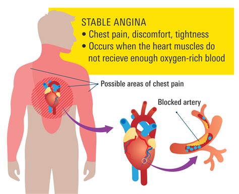 Stable Angina Chest Pain Explained