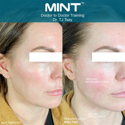 Mint™ Pdo Non Surgical Threads Behr Laser And Skin Care Center