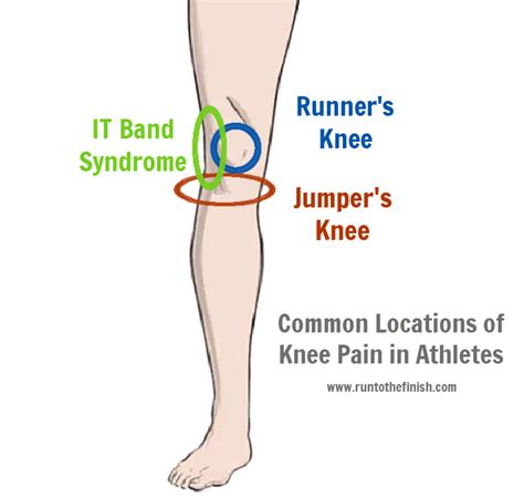 Treatment for Runner’s Knee vs. Jumper’s Knee