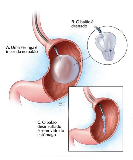 Balão Intragástrico Clínica Cirúrgica Chapecó Chapecó