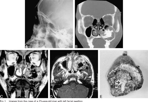 Figure 1 From Extraosseous Calcifying Epithelial Odontogenic CT And MR