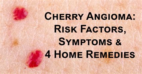 Cherry Angioma