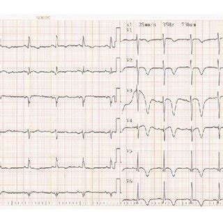 Twelve Lead ECG Of The Patient Sinus Rhythm 73 P Minute Axis Of 5