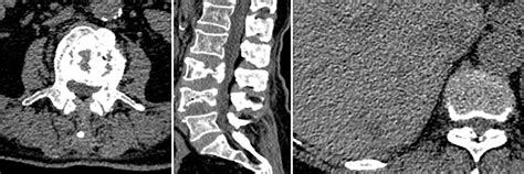 Frontiers Imaging Findings And Clinical Features Of Primary Spinal