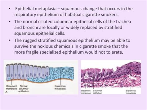 Metaplasia & Dysplasia | PPT