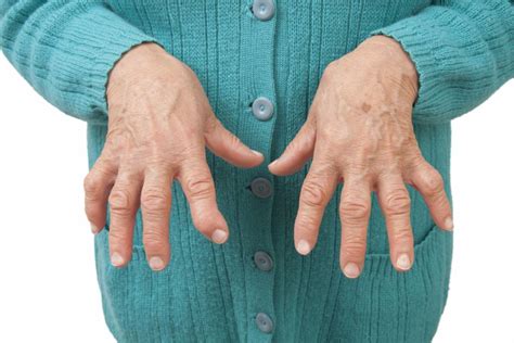 Rheuma Rheumatoide Arthritis Ursachen Symptome Therapie