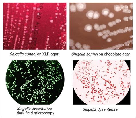 Foodborne Infection By Shigella Shigellosis Food Poisoning