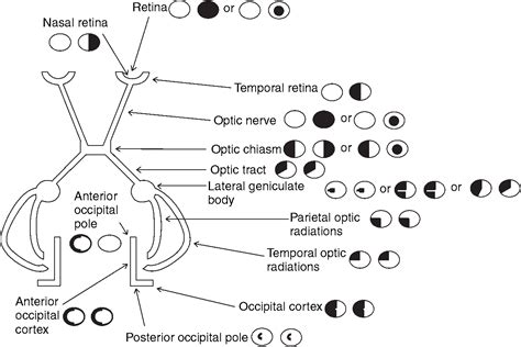 Neurological Visual Field Defect