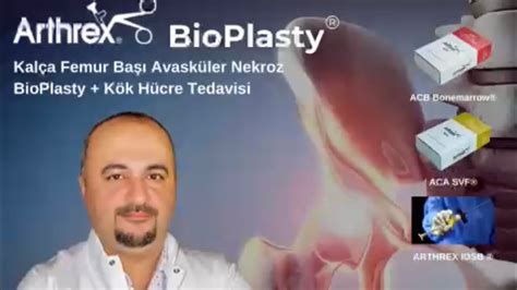 Arthrex Intraosseous Bioplasty Iobp Kal A Femur Ba Avask Ler