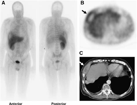 Anterior And Posterior Whole Body Planar A And Transverse Spect B