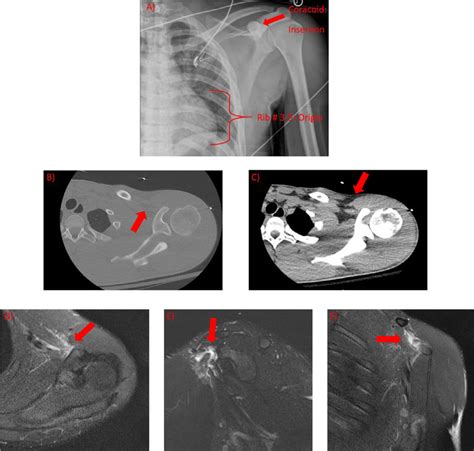 A Anteroposterior Ap Radiograph Of The Left Upper Extremity Shows An