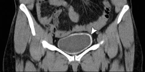 Squamous Cell Carcinoma Of The Bladder Complicating Schistosomiasis Airp Best Cases In