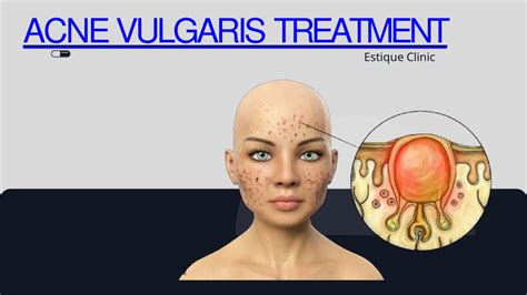 PPT - ACNE VULGARIS TREATMENT PowerPoint Presentation, free download - ID:11064818