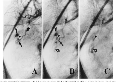 Figure 1 From Angiodysplasia Of The Appendix Semantic Scholar