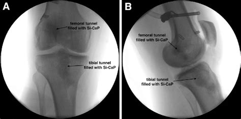 Anteroposterior A And Lateral B Intraoperative Fluoroscopy Of A